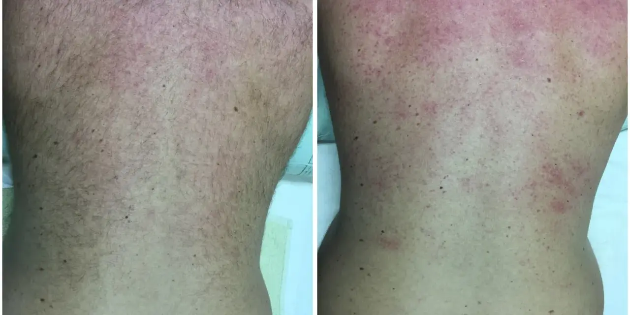 Comparación de la espalda antes y después de un intento de como depilarse la espalda uno mismo. La imagen de la derecha muestra irritación y enrojecimiento.
