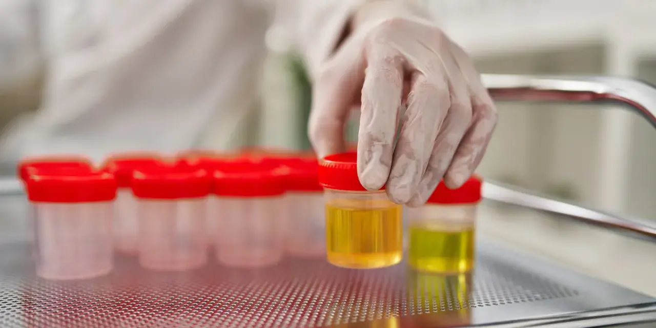 Ręka w rękawiczce laboratoryjnej wybiera pojemnik z żółtym płynem. W tle widać rząd podobnych pojemników. Badanie może wykazać ketony w moczu, a odwodnienie.