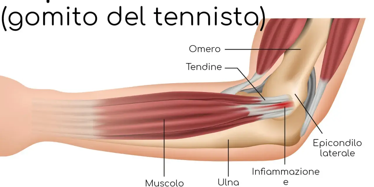 Illustrazione anatomica del gomito del tennista, evidenziando infiammazione e dolore all'epicondilo laterale.