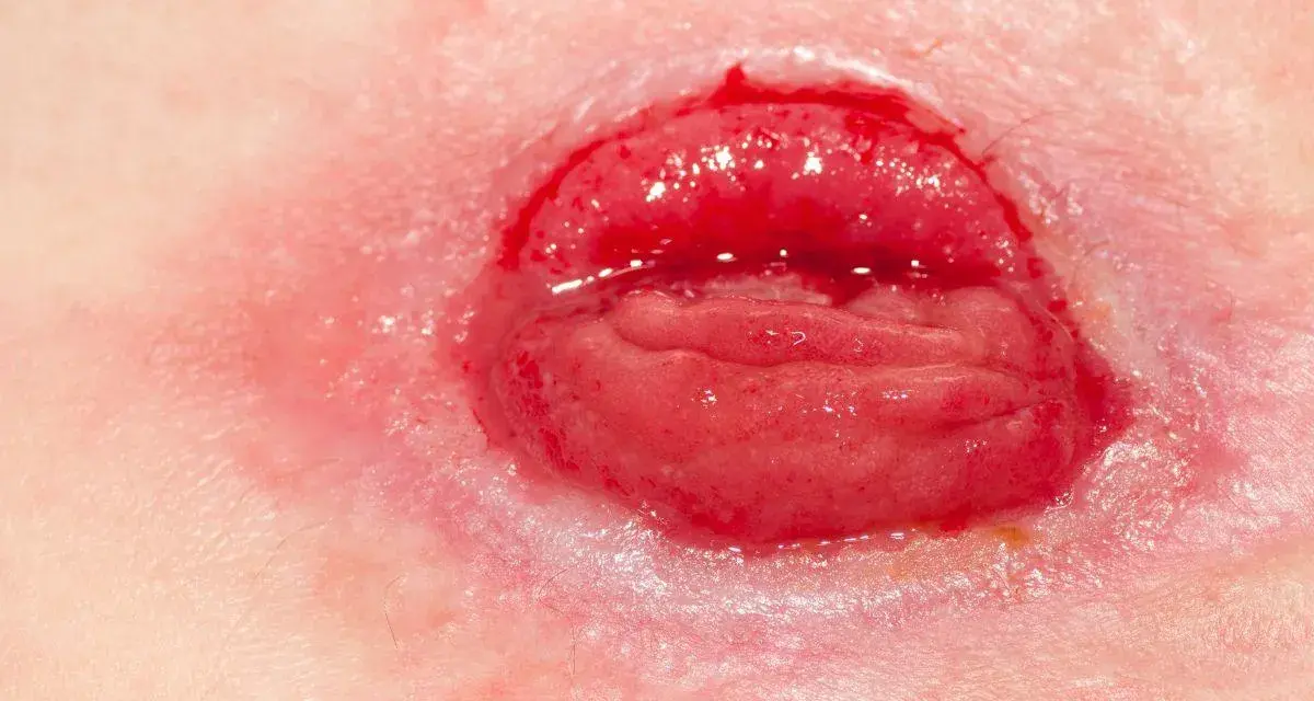 Zbliżenie na ileostomię, widoczny fragment jelita i zaczerwieniona skóra.