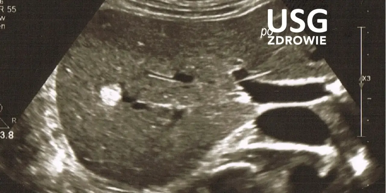 Obraz USG jamy brzusznej z widocznym jasnym ogniskiem. Czy usg jamy brzusznej wykryje raka? To badanie pomaga ocenić narządy wewnętrzne.