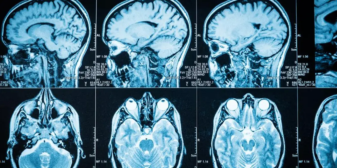 Guz mózgu objawy psychiczne: jak rozpoznać niebezpieczne sygnały