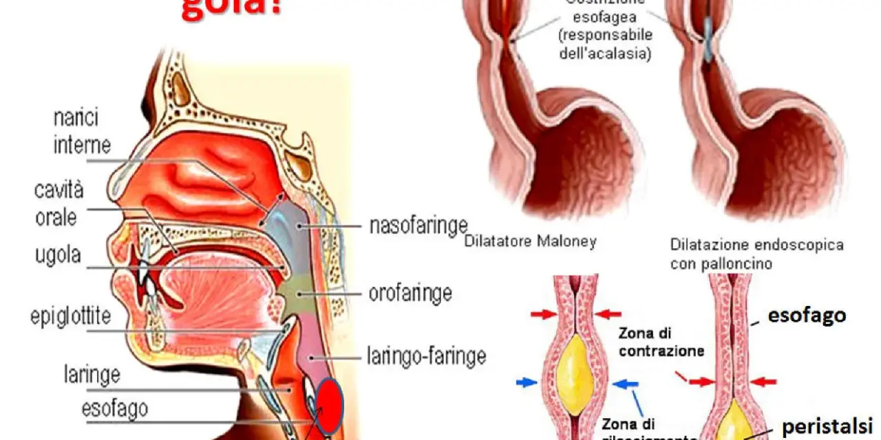 Illustrazione anatomica della gola e dell'esofago, che mostra come un bolo possa causare la sensazione di sentire qualcosa in gola.