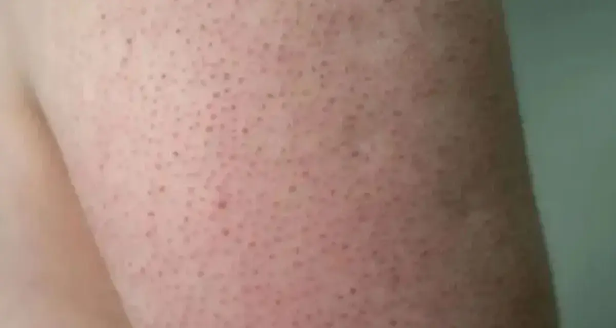 Piel de fresa con pequeños puntos oscuros, como si fueran semillas, en un brazo.