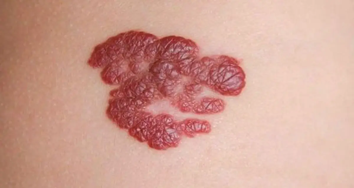 Ein roter, unregelmäßiger Hautfleck, der als mögliches Hautkrebs-Symptom betrachtet werden könnte.