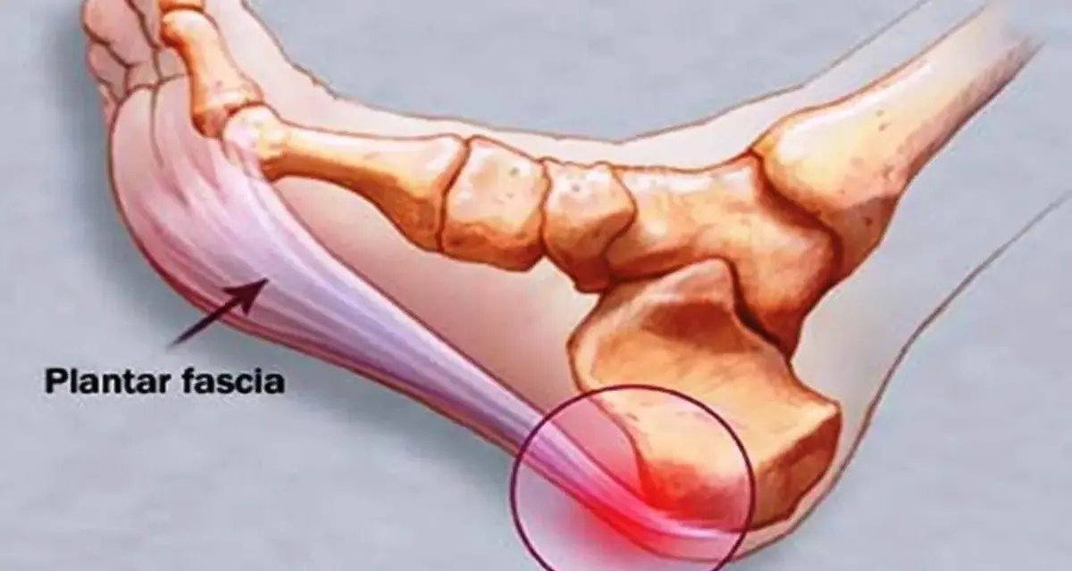 Illustration av fotens anatomi som visar plantar fascia och smärta vid plantar fasciitis.