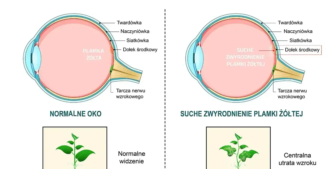 Porównanie normalnego oka z suchym zwyrodnieniem plamki żółtej. Obrazek pokazuje, jak obrzęk plamki żółtej wpływa na widzenie.