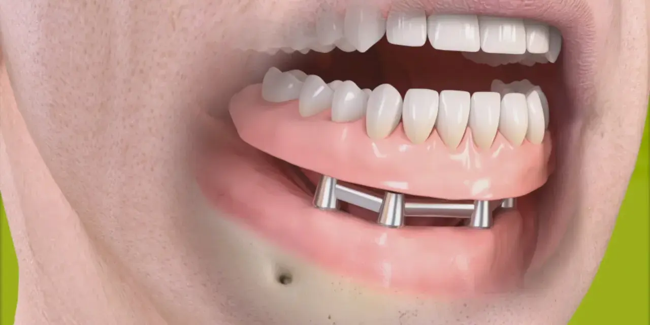 Implant zębowy: Bez bólu i strachu? Poznaj 5 etapów zabiegu