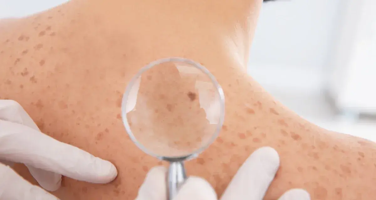 Dermatolog bada znamię na plecach pacjenta przez lupę. Skóra pokryta jest licznymi piegami i znamionami.