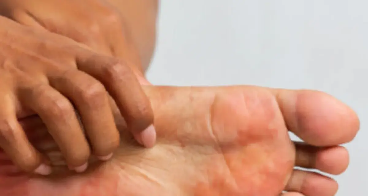 Una persona se rasca el pie, mostrando enrojecimiento e irritación. ¿Cómo saber si tengo hongos en los pies?
