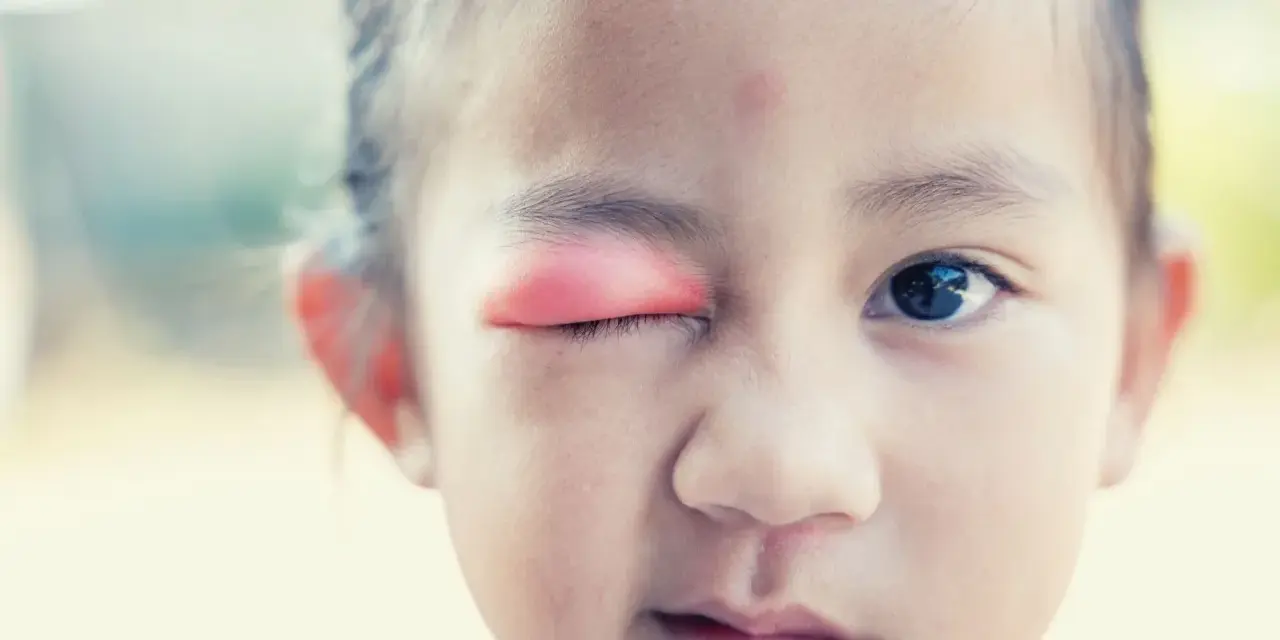 Bambina con occhio gonfio e arrossato, possibile segno di infezione o allergia. Le cause degli occhi gonfi nei bambini sono varie.