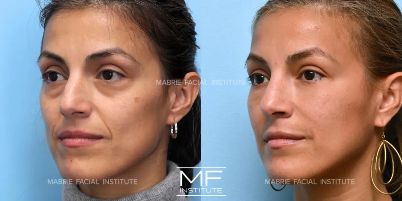 Before and after images show a woman's face, highlighting the reduction of nasolabial folds after a facial massage.