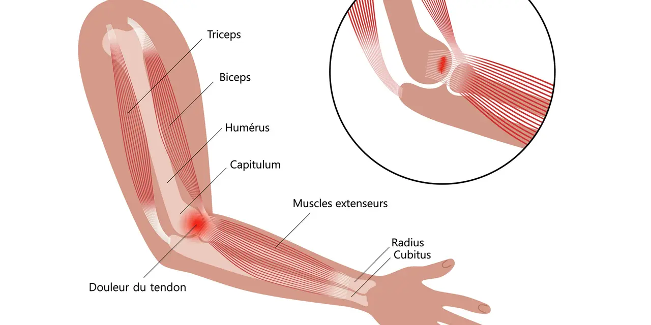 Illustration anatomique montrant une tendinite à l'intérieur du coude, avec douleur au tendon des muscles extenseurs.