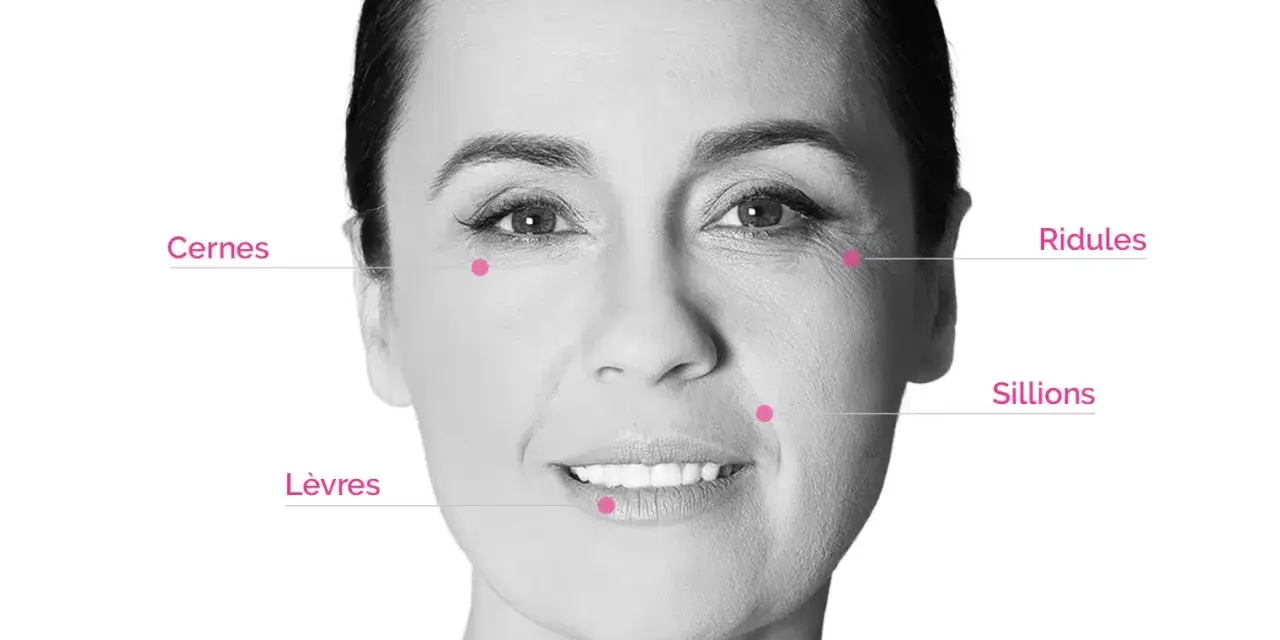 Visage marqué par des rides et cernes. Des points indiquent les zones d'application pour un avis sur l'acide hyaluronique.