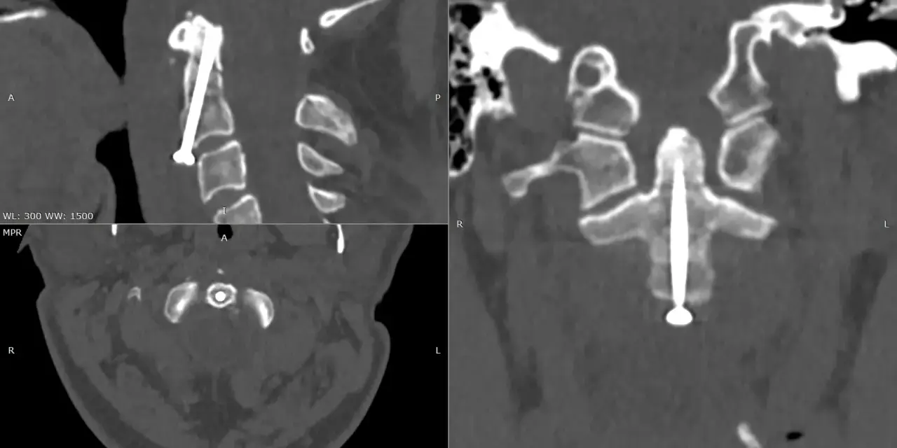 Widok CT kręgosłupa szyjnego po operacji. Widoczny implant stabilizujący, śruba przechodzi przez ząb obrotnika.