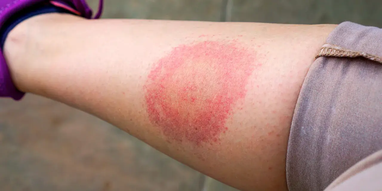 Borrelien Symptome beim Menschen: Warnzeichen, die Sie nicht ignorieren sollten