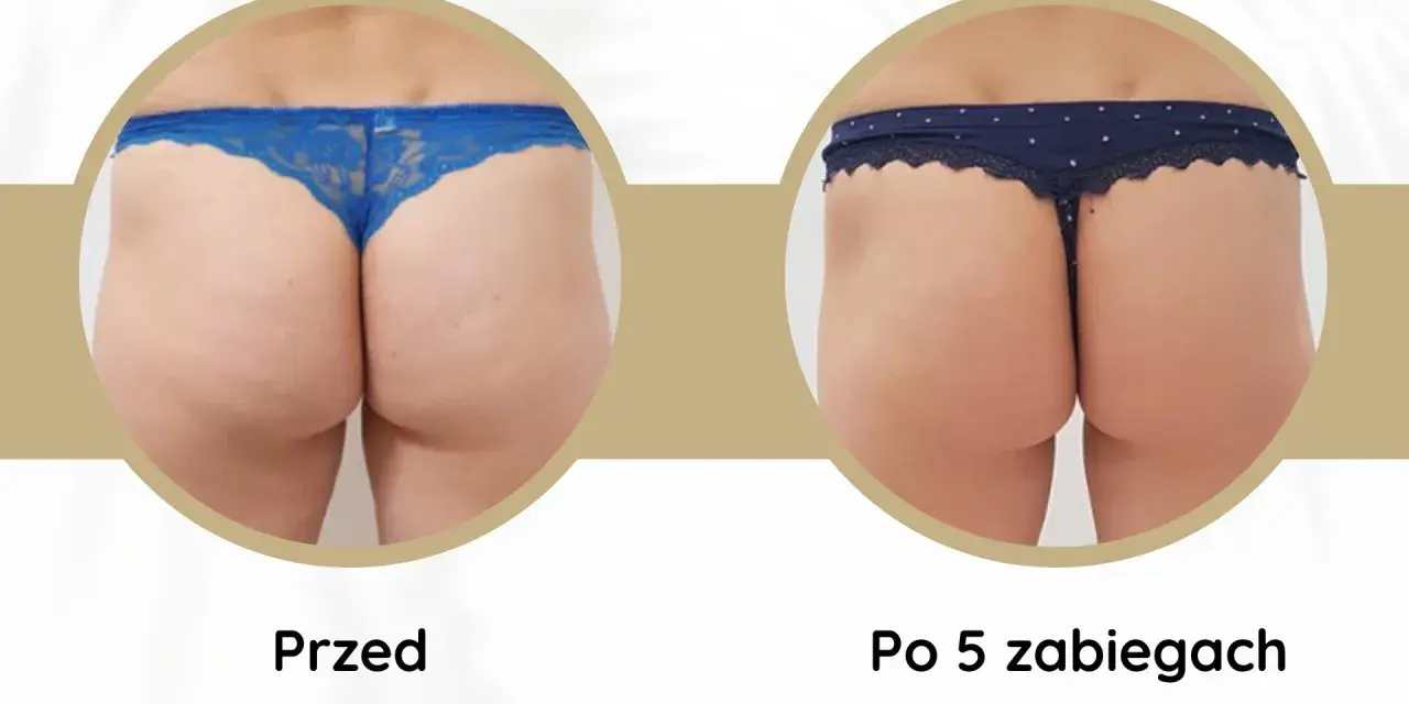Porównanie pośladków przed i po 5 zabiegach endermologii. Widoczna poprawa jędrności i redukcja cellulitu.