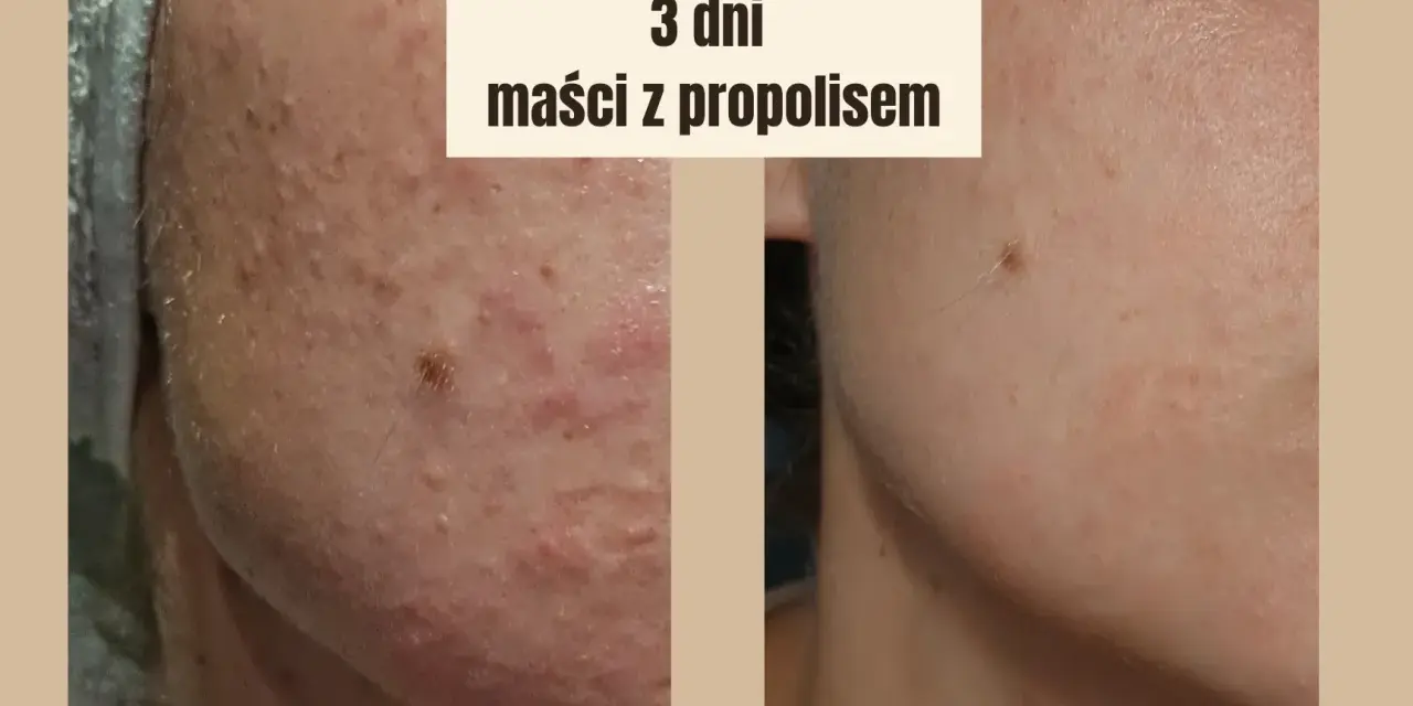 Przed i po zastosowaniu maści z propolisem: skóra z niedoskonałościami po 3 dniach kuracji wygląda znacznie lepiej.
