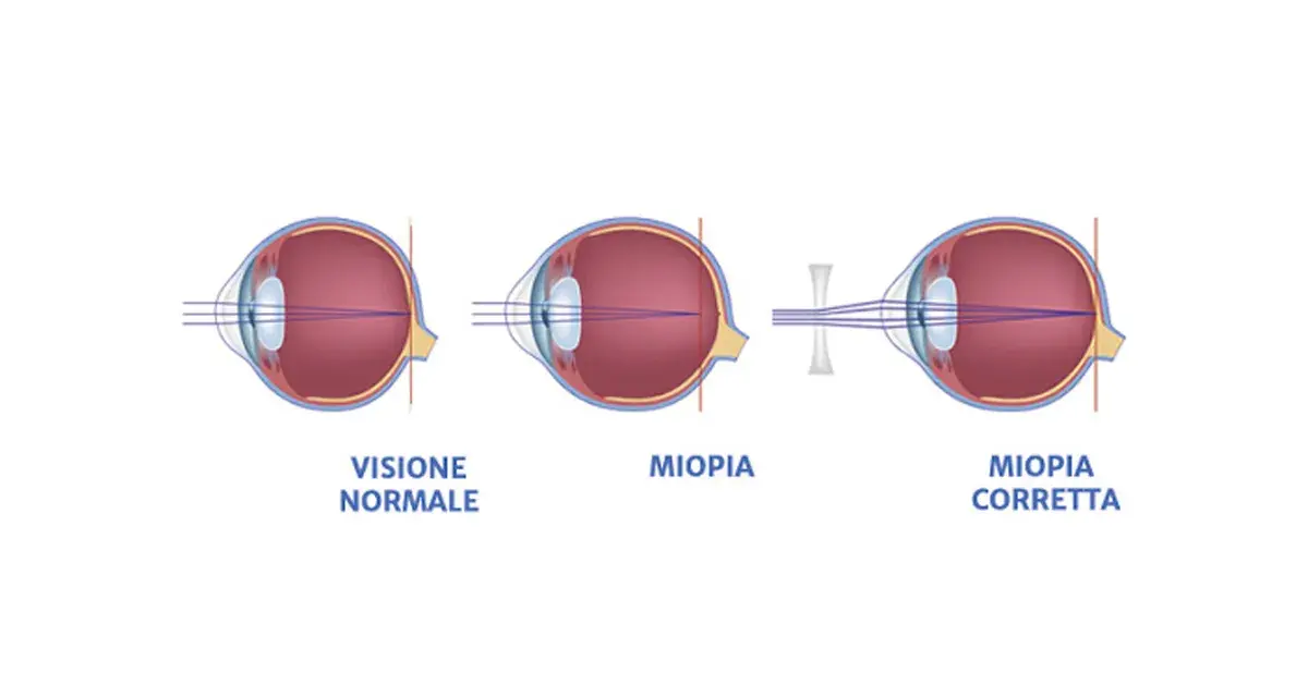 Diagrammi oculari mostrano visione normale, miopia e miopia corretta. I sintomi della miopia degenerativa sono visibili nel secondo occhio.