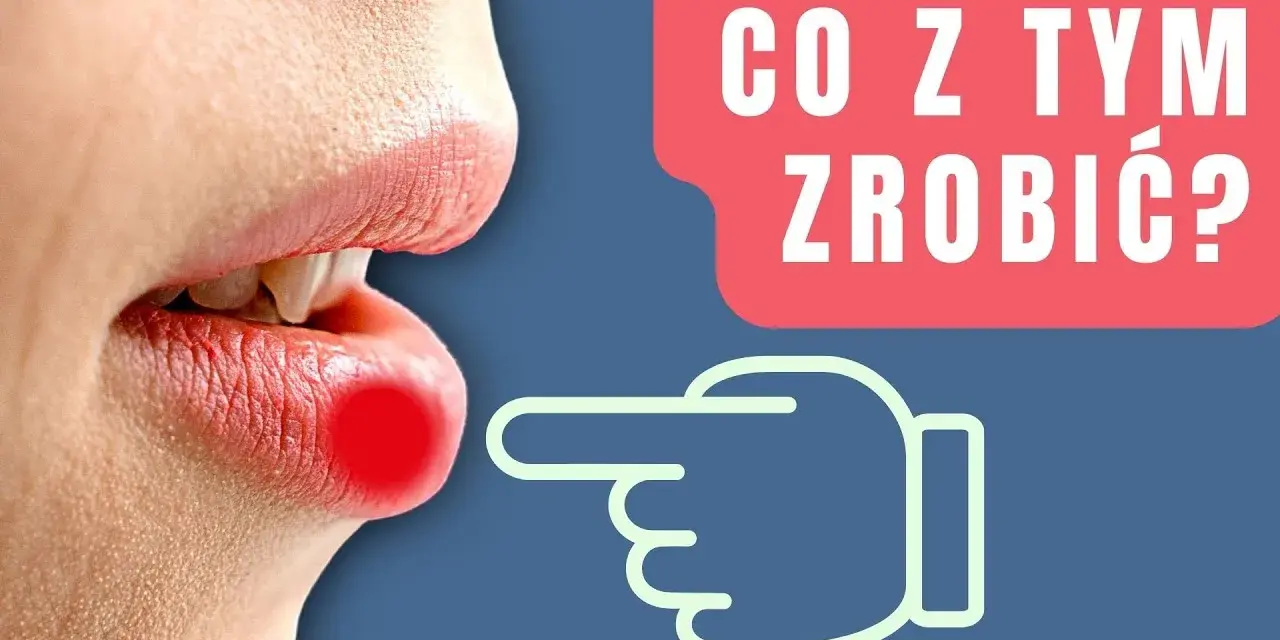 Jak skutecznie pozbyć się pryszcza na ustach i uniknąć infekcji
