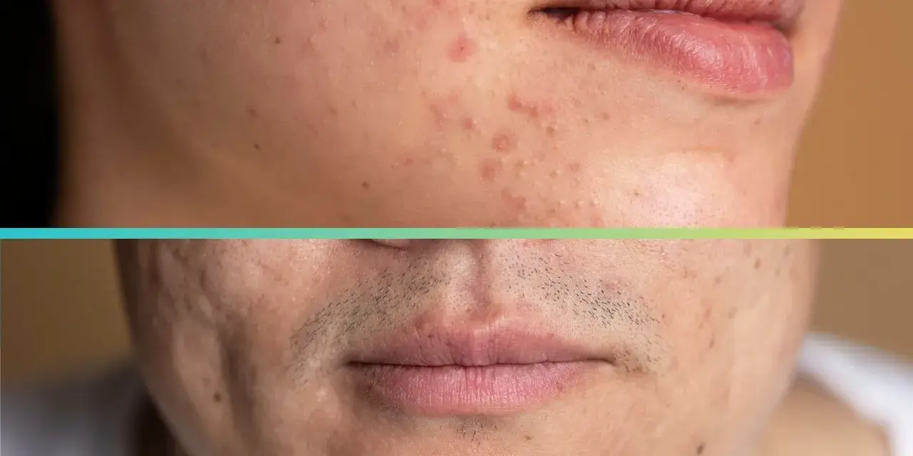Primo piano di un volto con macchie da acne, prima e dopo il trattamento dermatologico.