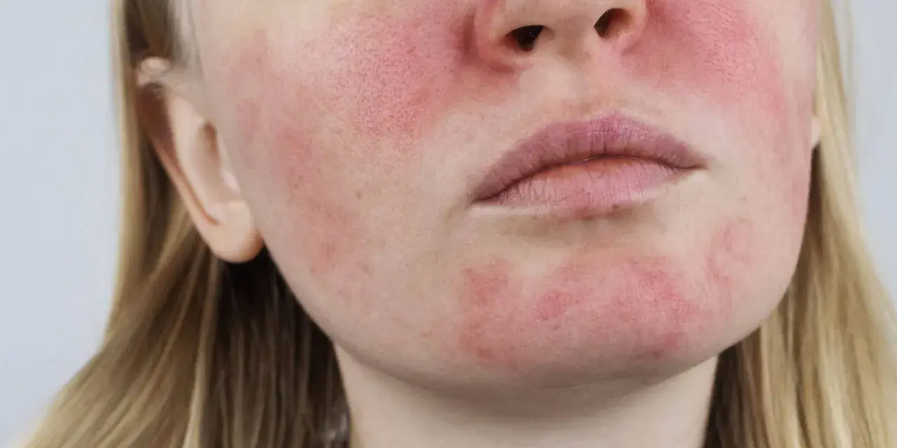 Nahaufnahme eines Gesichts mit Rötungen und sichtbaren Poren, die auf Rosacea und fettige Haut hindeuten.