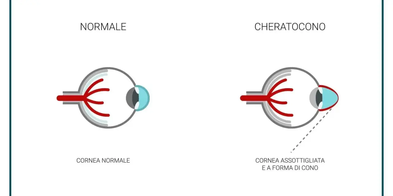 Confronto tra occhio normale e occhio con cheratocono, evidenziando la cornea assottigliata e a forma di cono, uno dei principali cheratocono sintomi.