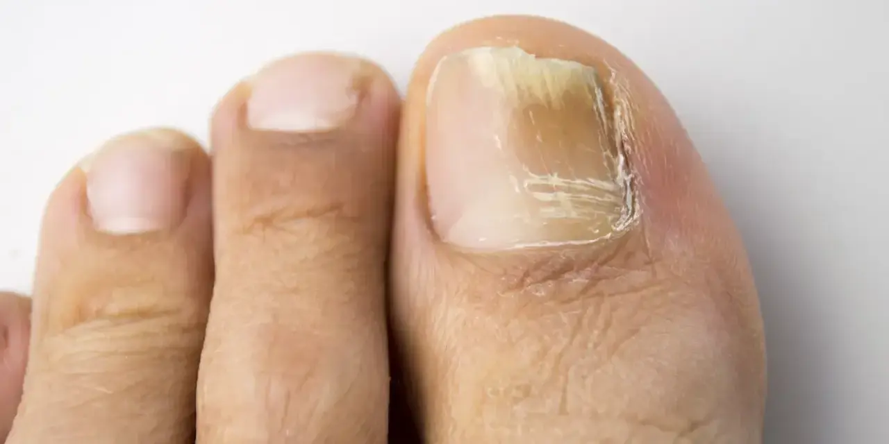 Gros plan sur un ongle de pied atteint de mycose, jauni et épaissi. Une solution naturelle à base d'huile essentielle pourrait aider.