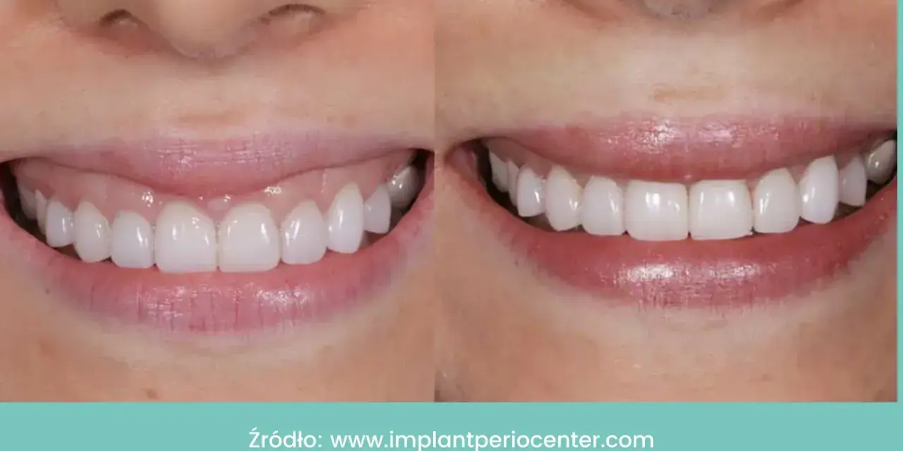 Uśmiech przed i po: zredukowany gummy smile, odsłonięte piękne, białe zęby.