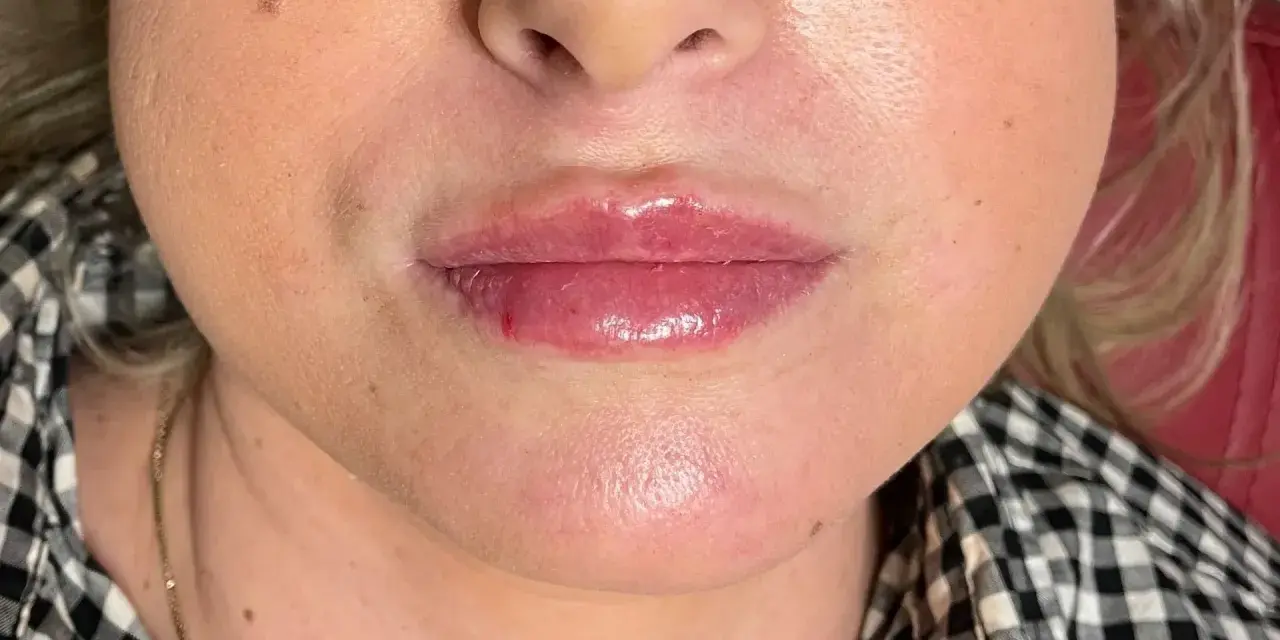 Powiększone, błyszczące usta po zabiegu, przypominające kacze usta po kwasie. Widoczne lekkie zaczerwienienie i obrzęk.