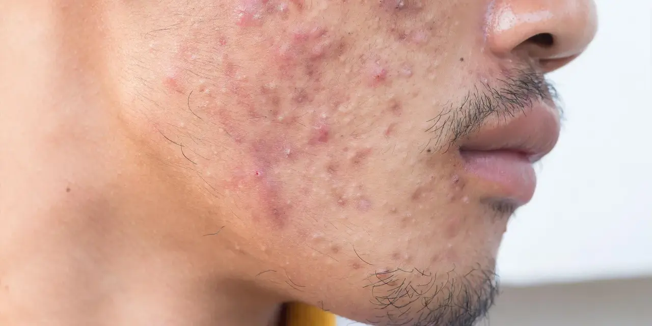 Primer plano de un rostro con acné severo, mostrando granos de pus grandes y enrojecimiento.