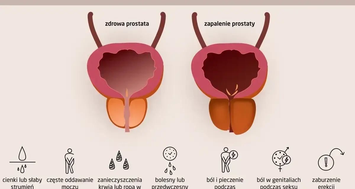 Porównanie zdrowej prostaty i zapalenia prostaty. Objawy zapalenia prostaty: słaby strumień moczu, ból, pieczenie, zaburzenia erekcji.