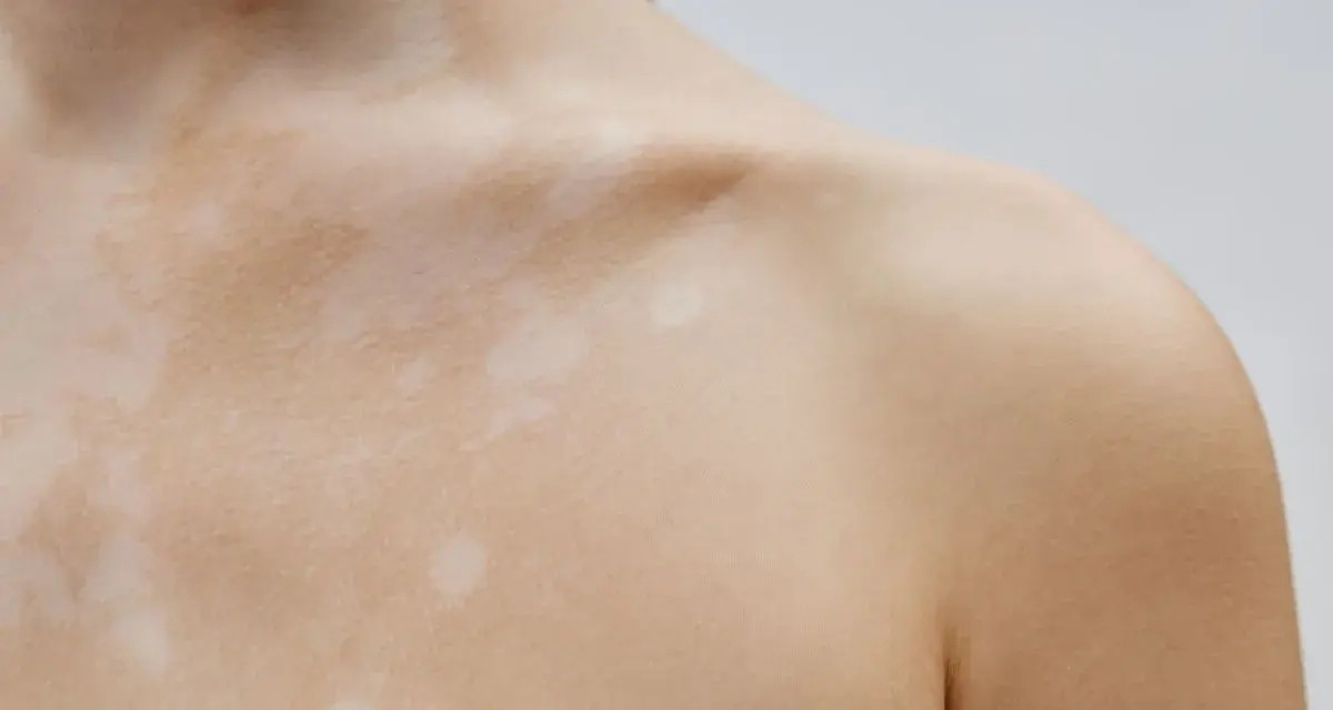 Piel con manchas claras, como si fueran **hongos en la espalda**, cubriendo el cuello y hombro.