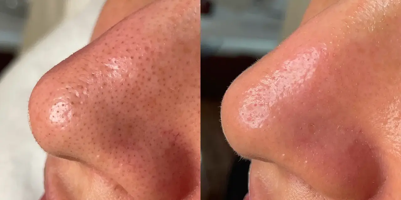 Before and after a hydro infusion facial, showing a nose with visible pores and blackheads transformed into smoother, clearer skin.
