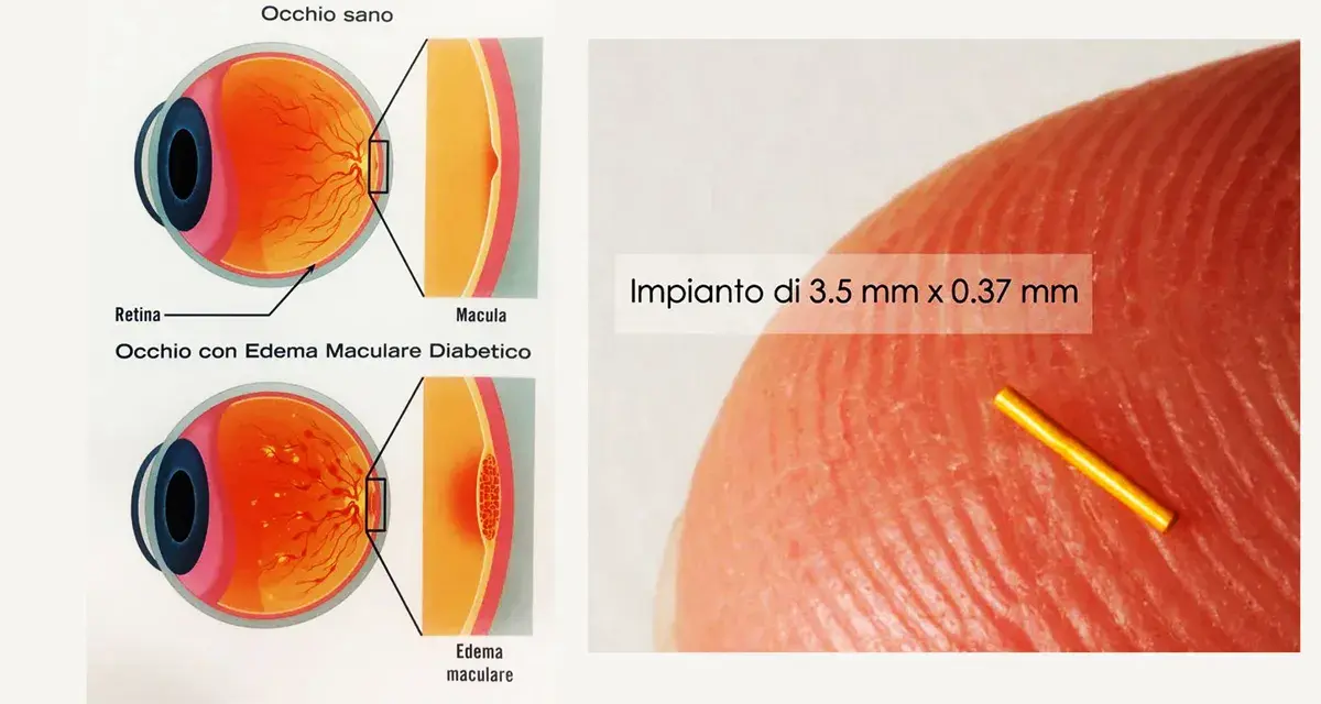 Illustrazione occhio sano vs. occhio con edema maculare diabetico, causa di edema retinico. Impianto microscopico.