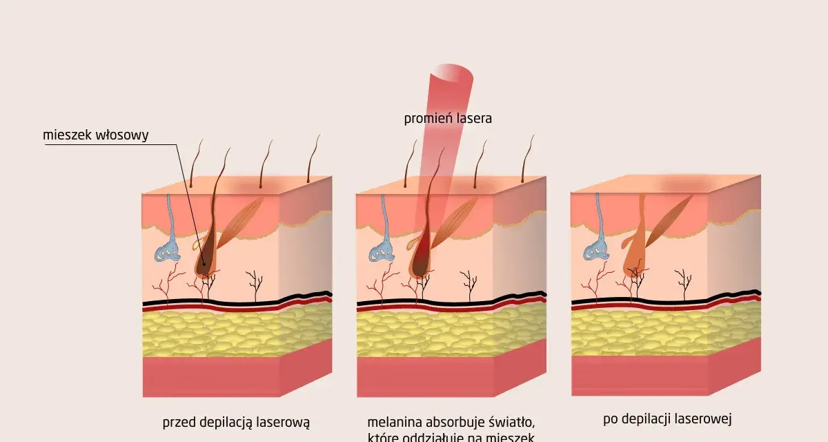 Ilustracja pokazuje, jak działa depilacja laserowa. Czy depilacja laserowa jest bezpieczna? Laser celuje w melaninę we włosie, niszcząc go.