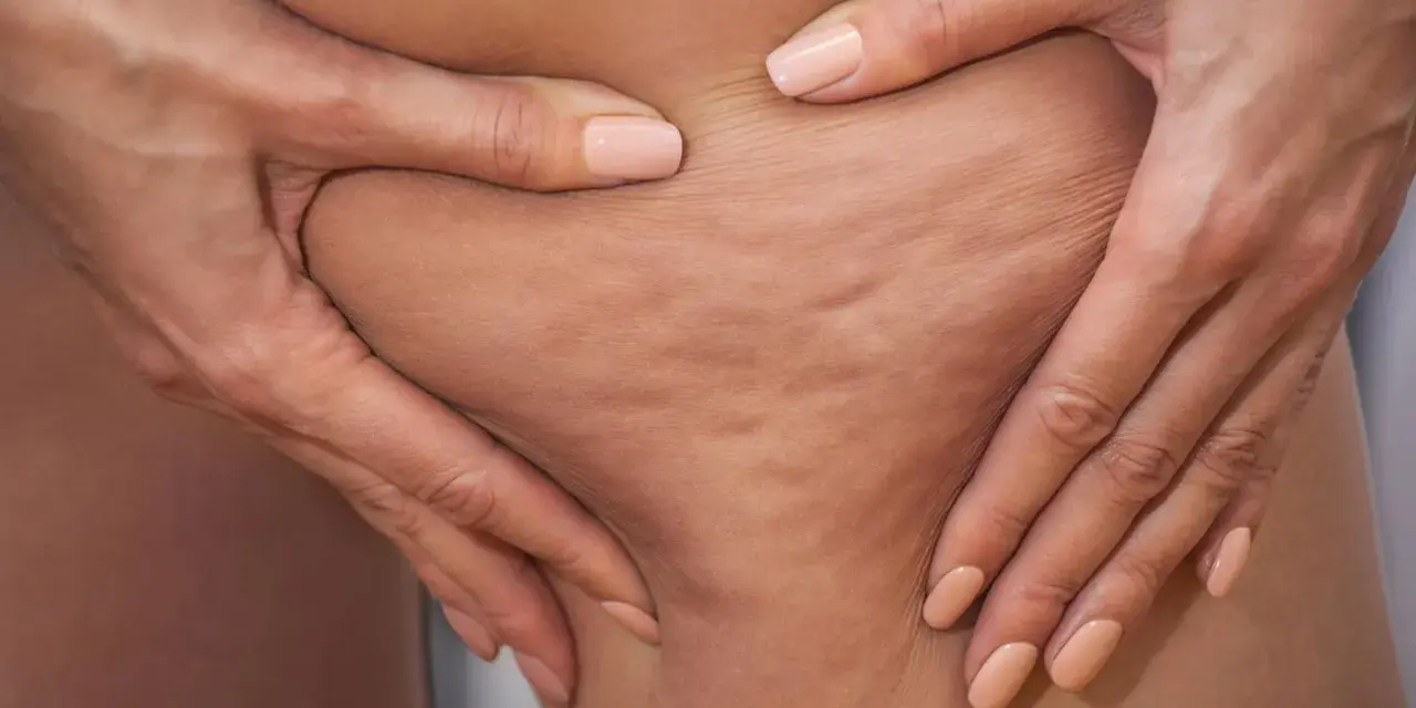 Hände greifen in die Haut an den Oberschenkeln, um Cellulite an den Beinen zu zeigen.
