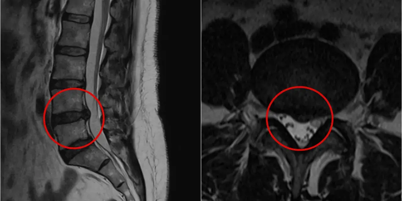 MRI kręgosłupa lędźwiowego z zaznaczoną przepukliną. Czy przepuklina kręgosłupa jest groźna? Obraz pokazuje, że tak, może uciskać nerwy.