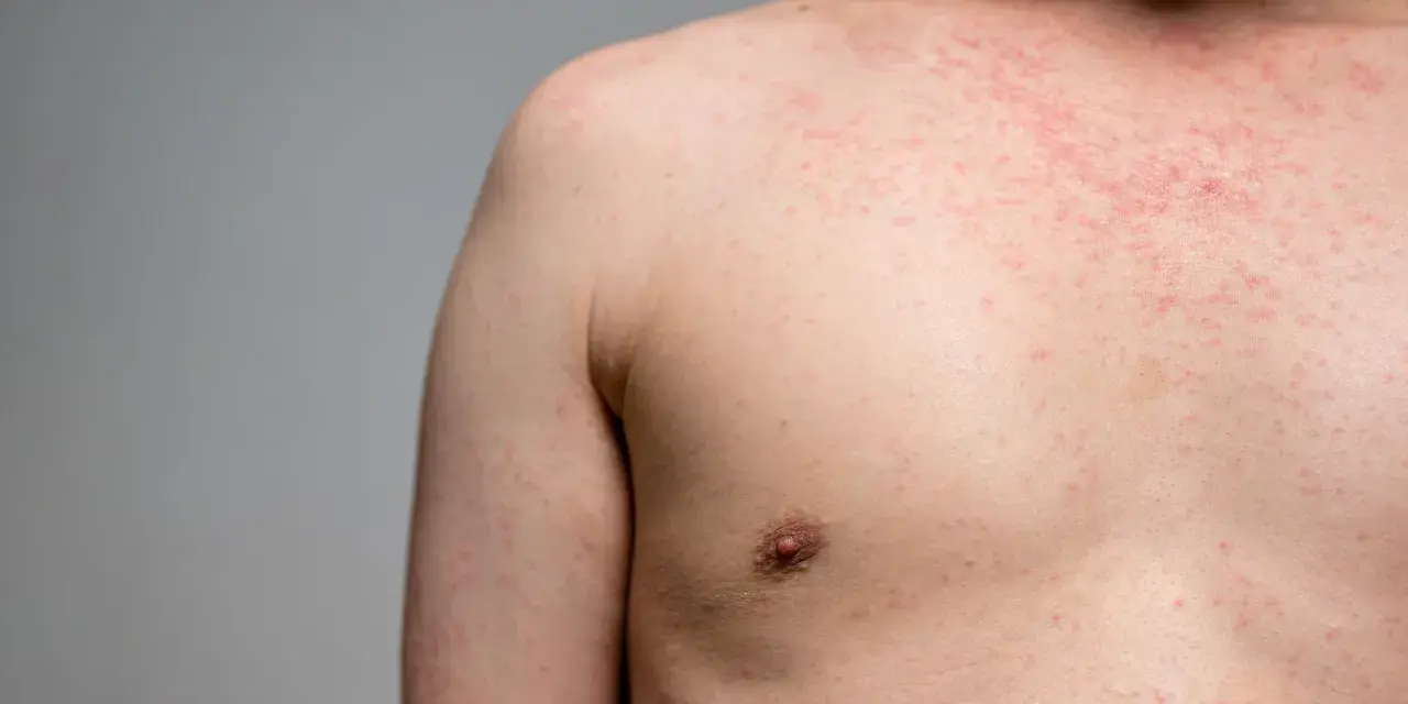 Eruzione cutanea rossa sul petto e sulla spalla, forse causata da un tessuto sintetico. L'elastan fa male alla pelle sensibile.