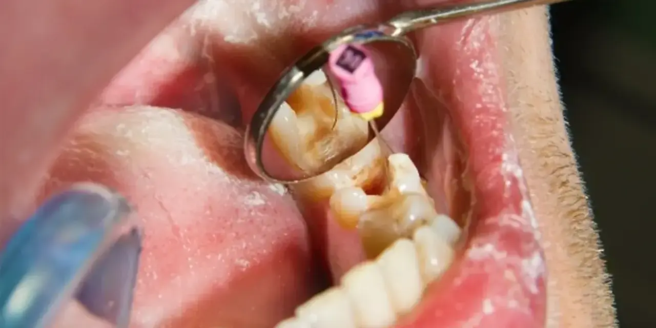 Zabieg stomatologiczny: martwy ząb jedynka w trakcie leczenia kanałowego. Widoczny instrument i lusterko dentystyczne.