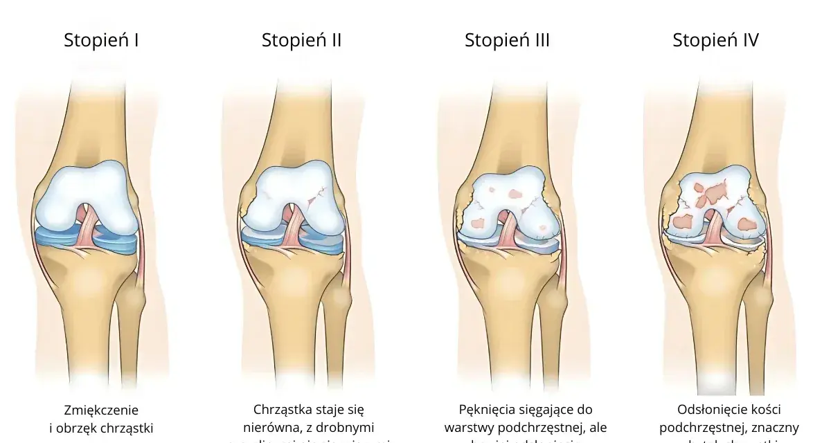 Stopień II chondromalacji rzepki: chrząstka staje się nierówna, z drobnymi szczelinami nie sięgającymi do warstwy podchrzęstnej.