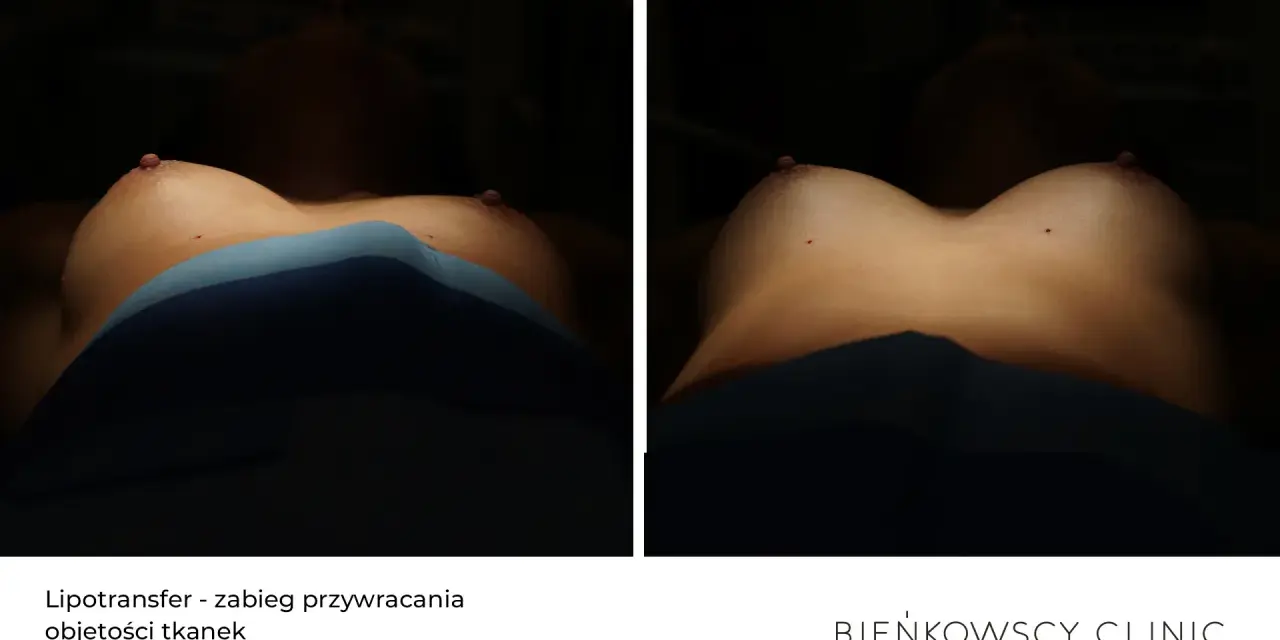 Lipotransfer biustu: porównanie efektów przed i po zabiegu. Widoczne piersi z zaznaczonymi punktami.