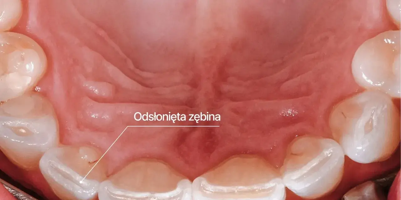 Odsłonięta zębina na zębach, objaw bruksizmu. Leczenie może obejmować szyny relaksacyjne.
