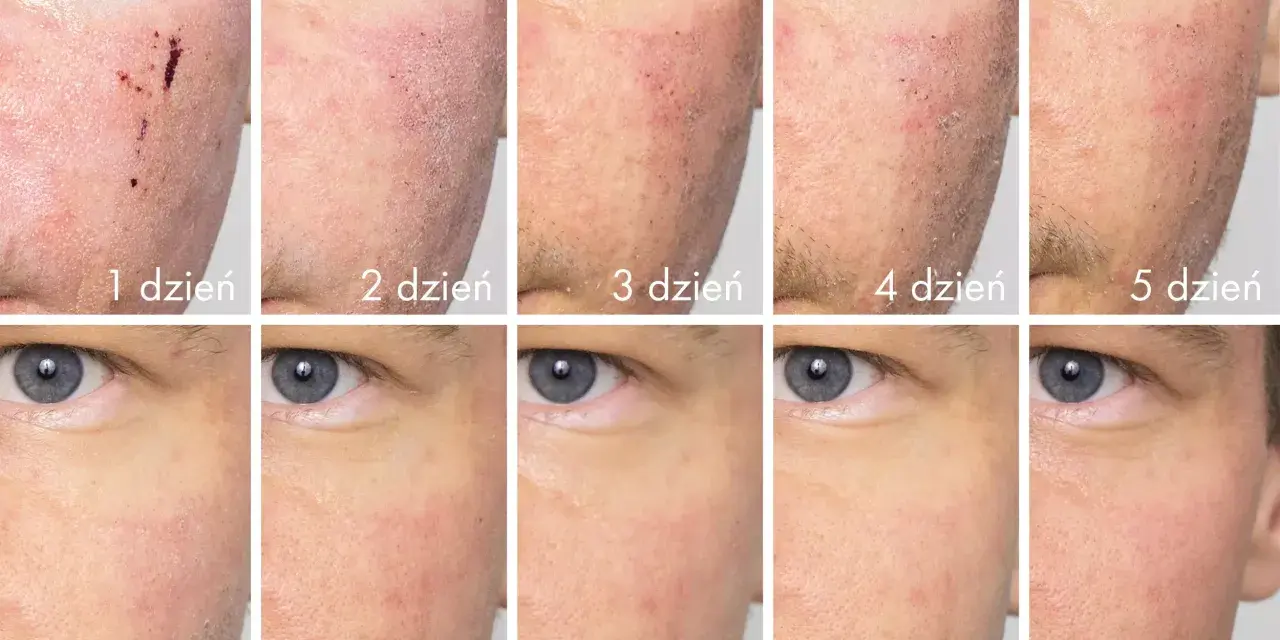 Post-laserowa regeneracja skóry: od 1. do 10. dnia widać, jak długo utrzymuje się opuchlizna i zaczerwienienie, aż do pełnego wygojenia.