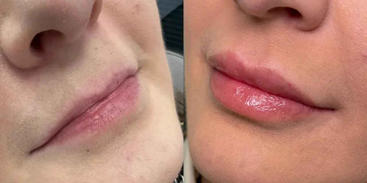 Powiększanie ust: Kwas hialuronowy, lip lift czy domowe triki?