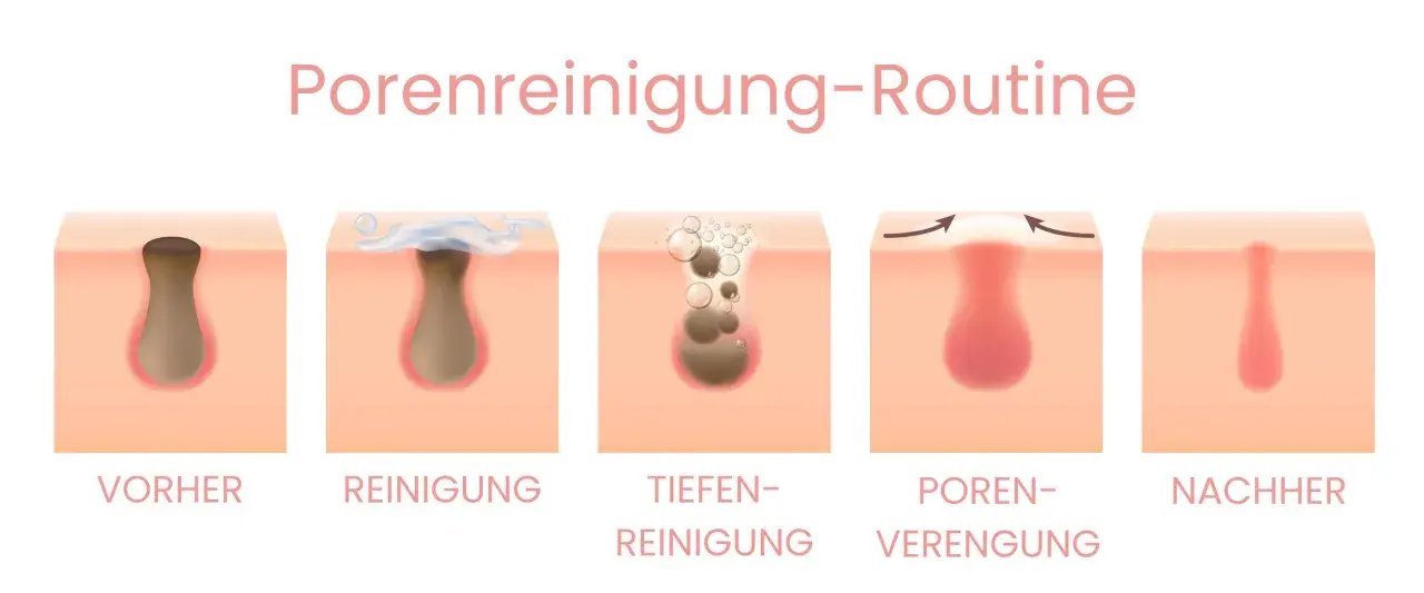 Illustration zeigt, woher kommen Mitesser: Talg und abgestorbene Hautzellen verstopfen Poren. Reinigung und Porenverengung helfen.