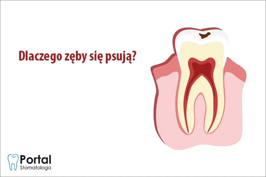 Od czego psują się zęby? Odkryj prawdziwe przyczyny i chroń uśmiech