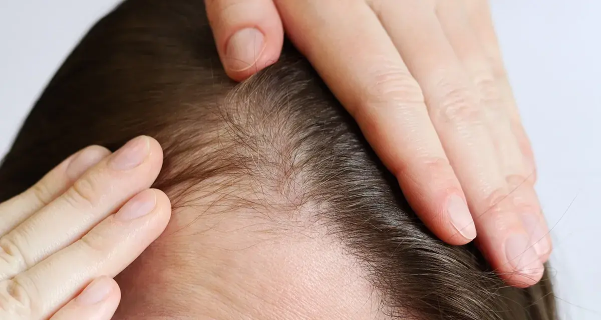 Manos tocando el cuero cabelludo, mostrando finos cabellos y piel. Podría indicar dolor cuero cabelludo o preocupación por la pérdida de cabello.