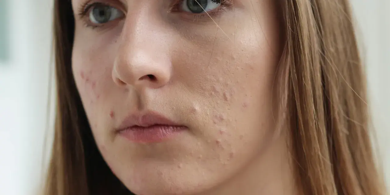 Młoda kobieta z niedoskonałościami na twarzy, być może stosująca sudocrem na twarz.