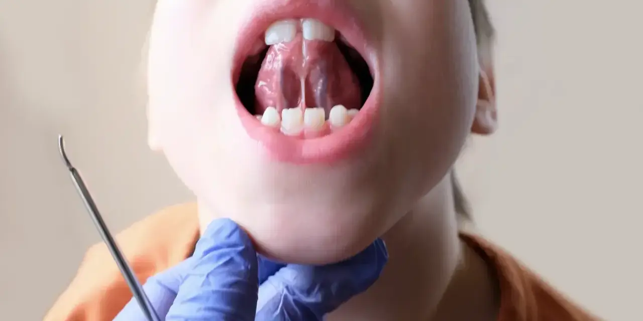 Dziecko otwiera usta, pokazując język przyrośnięty do dna jamy ustnej. Widoczny fragment wędzidełka językowego, które może wymagać podcięcia.